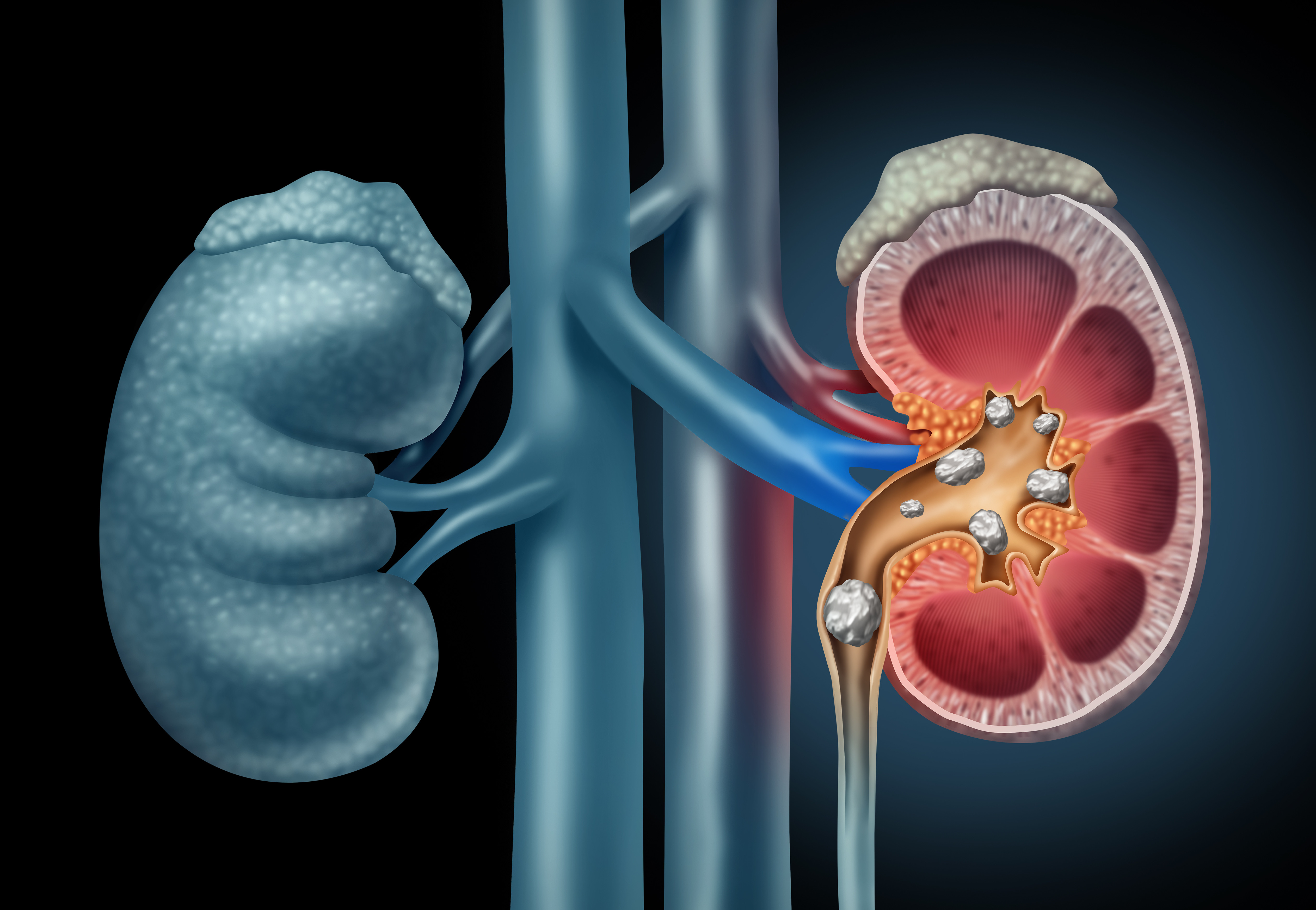 RIRS laser kidney stone surgery